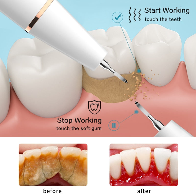 Ultrasonic Dental teeth scaler/cleaner